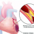 hyperlipidemia.png