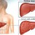 cirrhosis.jpg